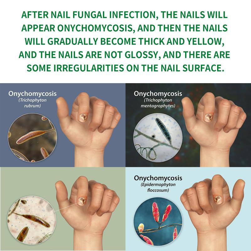 Ginger Nail Treatment for Support and Care - Polish and Art Manicure Moisturize nail thickness renewal nail thickness renewal cuticle strengthening